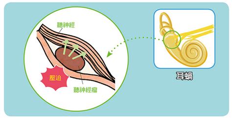 單側耳鳴原因|耳鳴原因有哪些？這3種耳鳴可能是疾病警訊、5招改善。